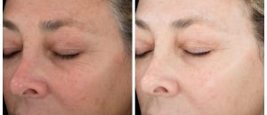 , Chemical Peels