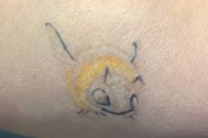 Laser Tattoo Removal San Antonio Tx Dr Robert Young